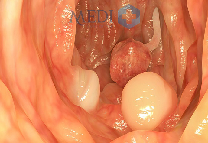 Polyp hậu môn có thể gây ra biến chứng nguy hiểm nếu không điều trị kịp thời