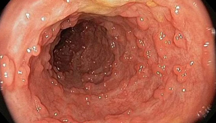 Polyp tăng sản đại tràng và đại tràng sigma ít khả năng phát triển thành ác tính