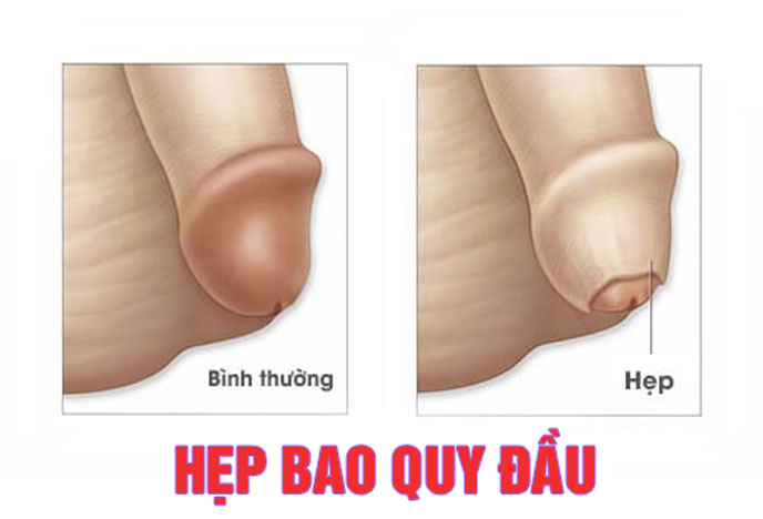 Hẹp bao quy đầu có quan hệ được hay không