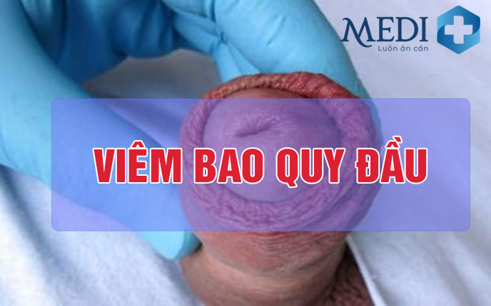 Viêm bao quy đầu bệnh lý phổ biến ở nam giới