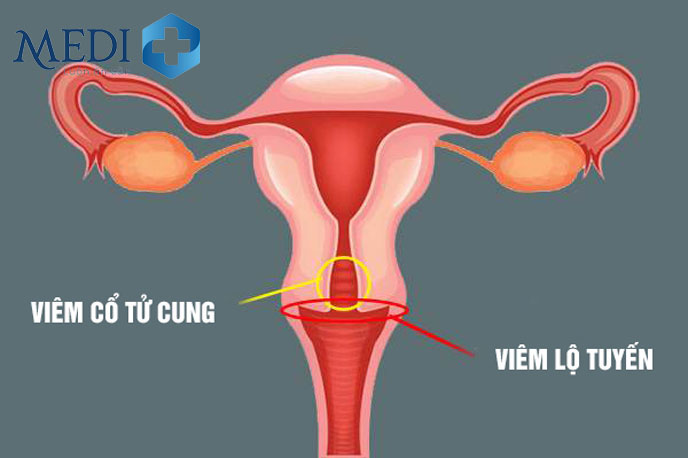 Vị trí viêm cổ tử cung và viêm lộ tuyến cổ tử cung theo mô hình học.