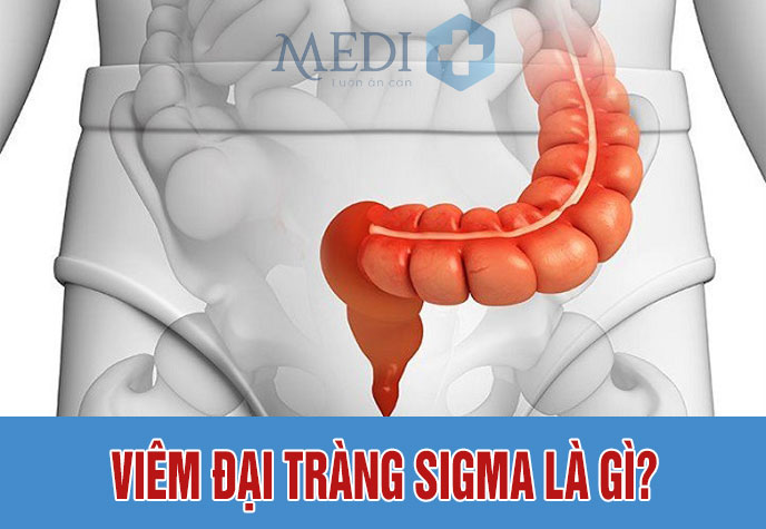 Viêm đại tràng sigma là gì, có nguy hiểm không?