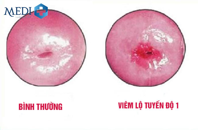 Viêm lộ tuyến cổ tử cung độ 1 bắt đầu có các biểu hiện ra ngoài