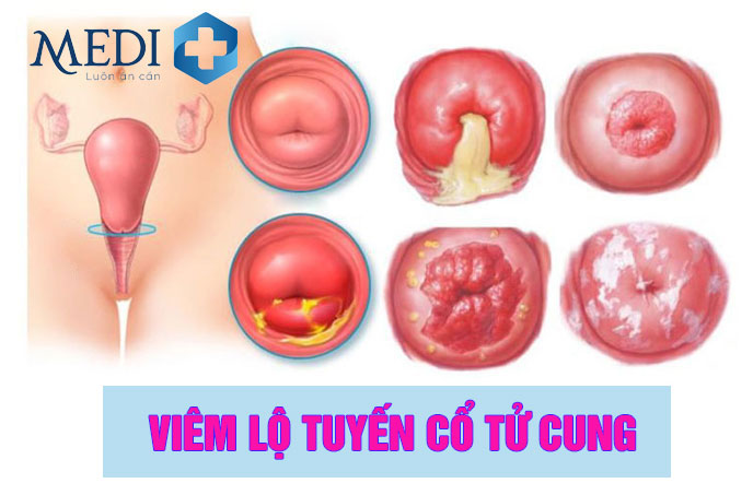 Viêm lộ tuyến cổ tử cung từng mức độ ở nữ giới cần LƯU Ý