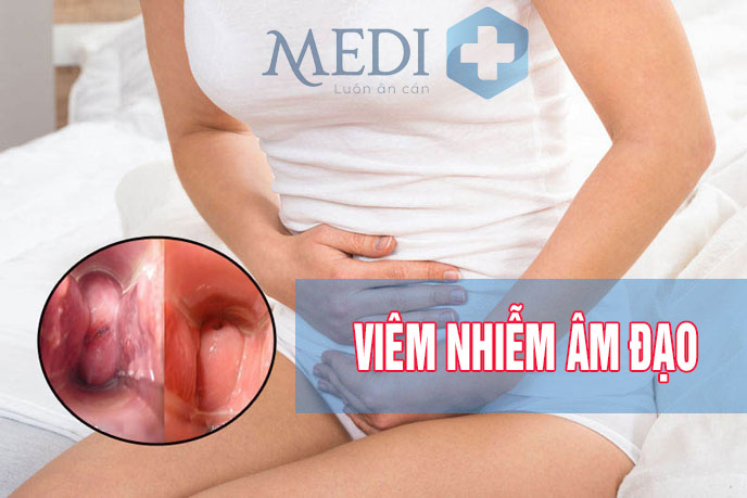 Viêm âm đạo: Bệnh lý khó nói, chữa thế nào cho dứt điểm?