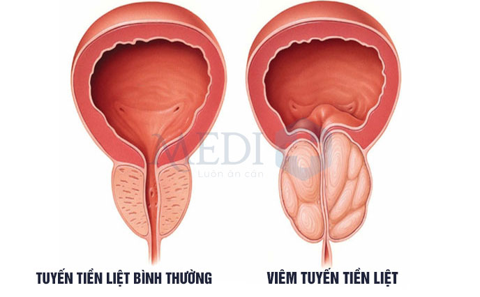 Viêm tuyến tiền liệt do nhiễm khuẩn và tiến triển khá nhanh