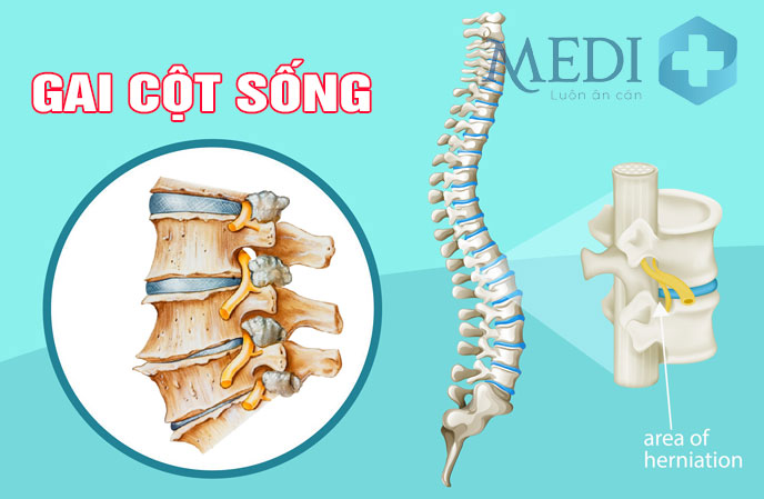 Gai cột sống có chữa được không? Bệnh nguy hiểm cần lưu ý