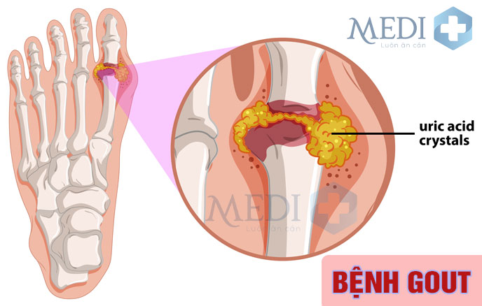 Bị bệnh gout