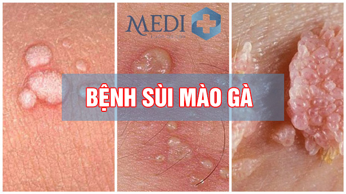 Bệnh sùi mào gà: Nguyên nhân, dấu hiệu nhận biết và các tác hại của bệnh