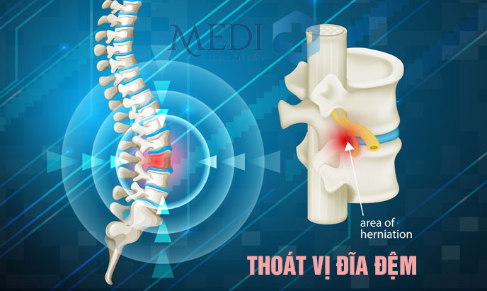 Bệnh thoát vị đĩa đệm