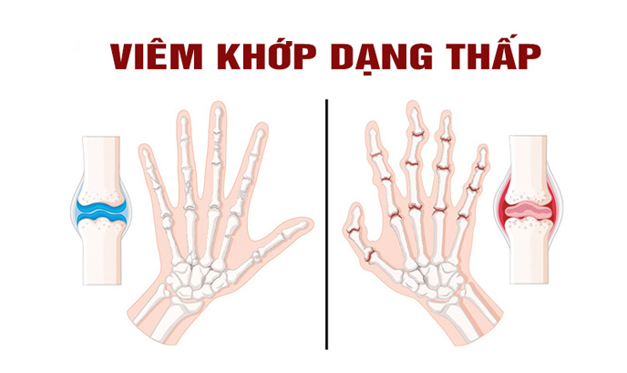 Bệnh viêm khớp dạng thấp