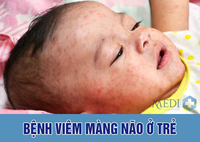 Bệnh viêm màng não ở trẻ em những dấu hiệu cảnh báo