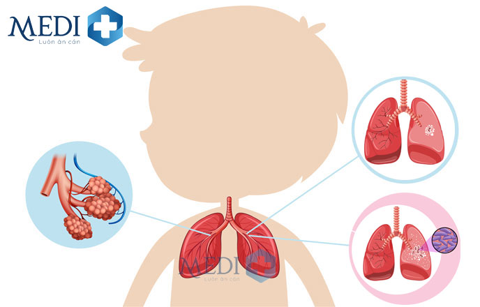 Bệnh viêm phổi ở trẻ em điến tiến nguy hiểm nguy cơ tử vong cao