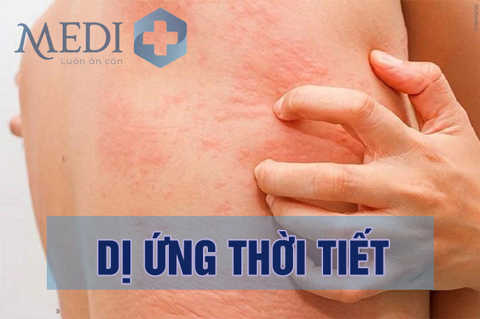 Dị ứng thời tiết nổi mề đay: Điều trị dứt điểm tránh tái phát