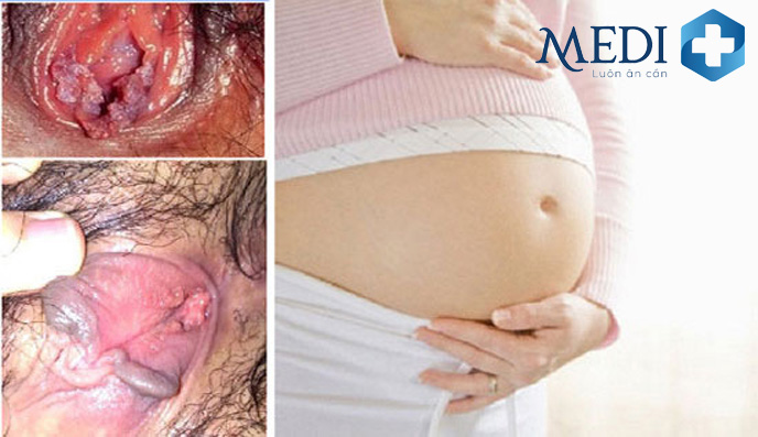 Các vấn đề khi mang thai và thai nhi liên quan đến bệnh sùi mào gà