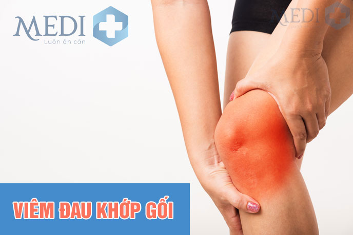 Viêm khớp gối đau nhức khó đi lại, biến chứng thoái hóa khớp