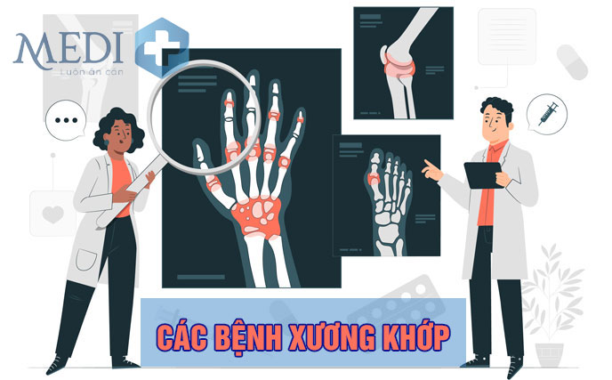 Các bệnh về cơ xương khớp thường hay gặp nhất (LƯU Ý)