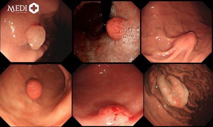 Polyp dạ dày phát hiện trong quá trình nội soi bệnh lý đường tiêu hóa