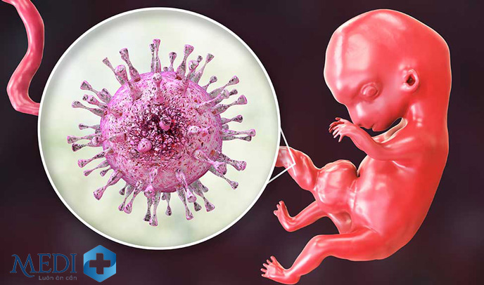 Virus cytomegalo gây sảy thai, sinh non