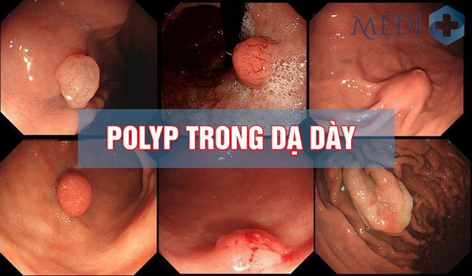 Polyp dạ dày là gì? Triệu chứng nhận biết và cách điều trị