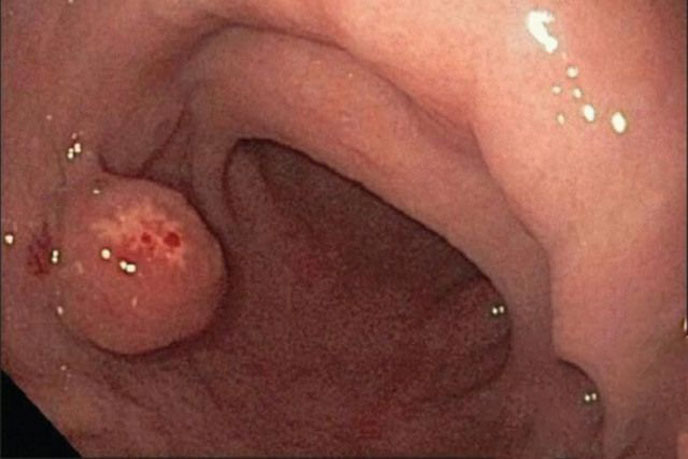 Polyp u tuyến có thể là dấu hiệu sớm của ung thư dạ dày