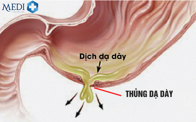 Vết thủng dạ dày do viêm loét dạ dày kéo dài và gây tràn dịch dạ dày