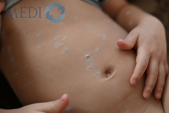 Giai đoạn phát bệnh, trẻ xuất hiện các nốt mẩn trên da