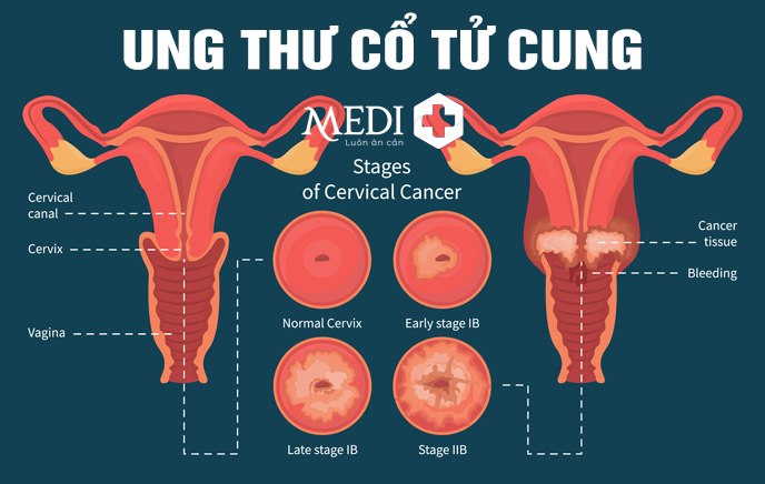 Ung thư cổ tử cung