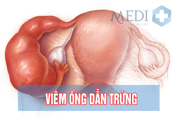 Viêm ống dẫn trứng và các biến chứng nguy hiểm