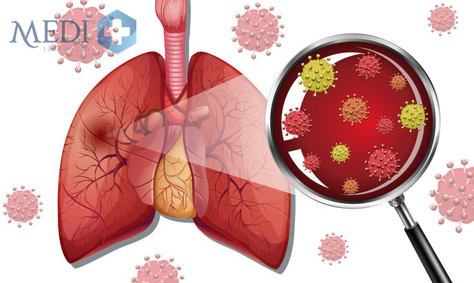 Viêm phổi ở trẻ nguyên nhân chủ yếu do vi khuẩn gây ra