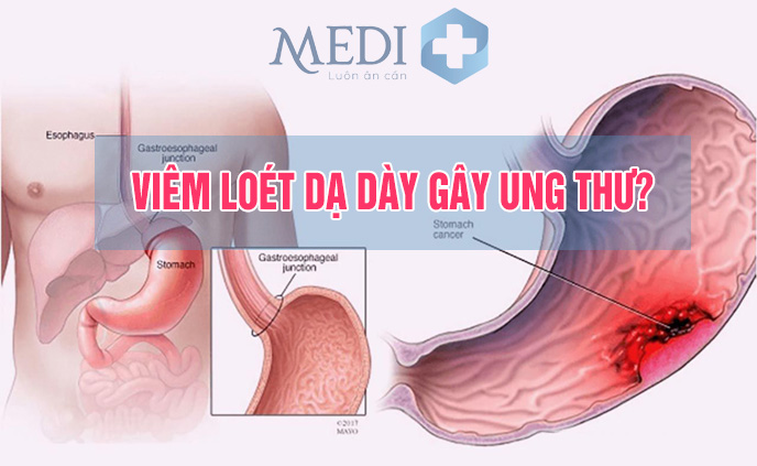 Viêm loét dạ dày có nguy hiểm không, có dẫn đến ung thư?