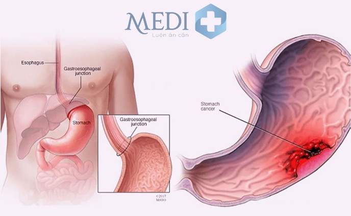 Viêm loét dạ dày làm tăng nguy cơ gây ung thư