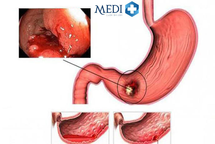 Xuất huyết dạ dày do viêm loét dạ dày