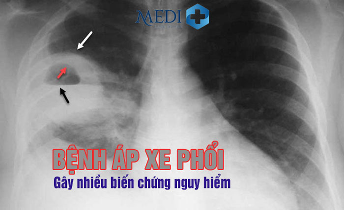 Áp xe phổi: Nguyên nhân, dấu hiệu nhận biết và cách điều trị