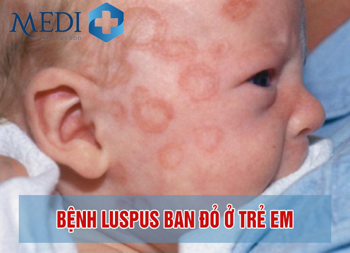 Bệnh lupus ban đỏ, một dạng bệnh lý mạn tính gây sưng viêm khắp người