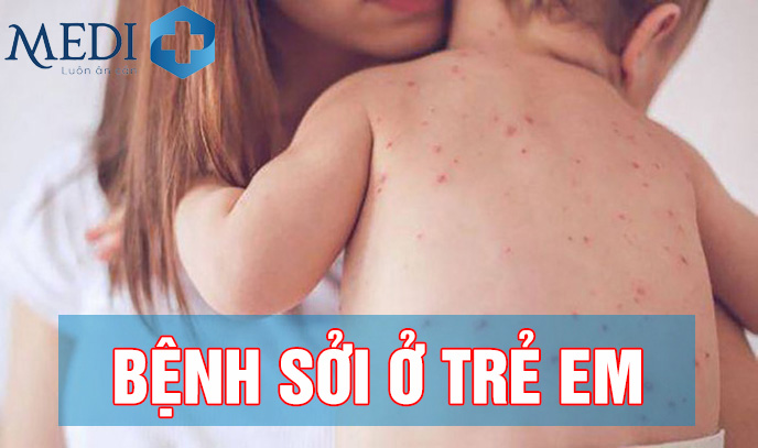 Bệnh sởi ở trẻ em: Diễn biến nhanh và nguy hiểm cha mẹ cần lưu ý