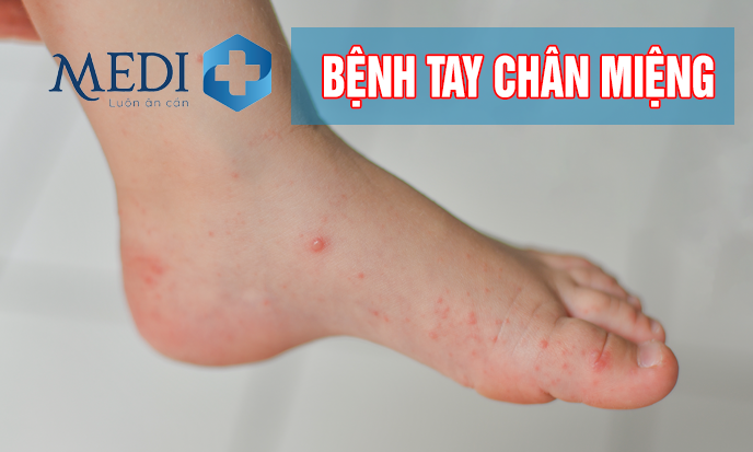 Bệnh tay chân miệng cảnh giác dấu hiệu chuyển nặng, cách chăm sóc cho trẻ nhỏ