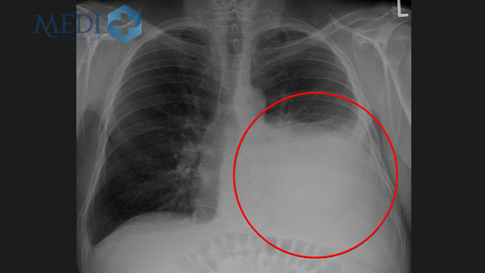 Hình ảnh tràn dịch màng phổi trên phim chụp X-quang