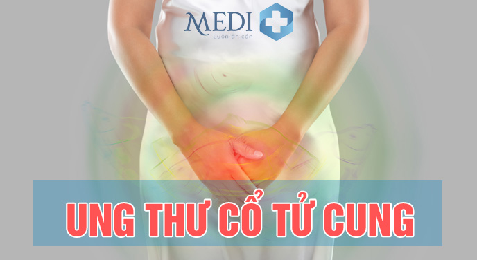 Ung thư cổ tử cung: Nguyên nhân, dấu hiệu nhận biết và cách điều trị