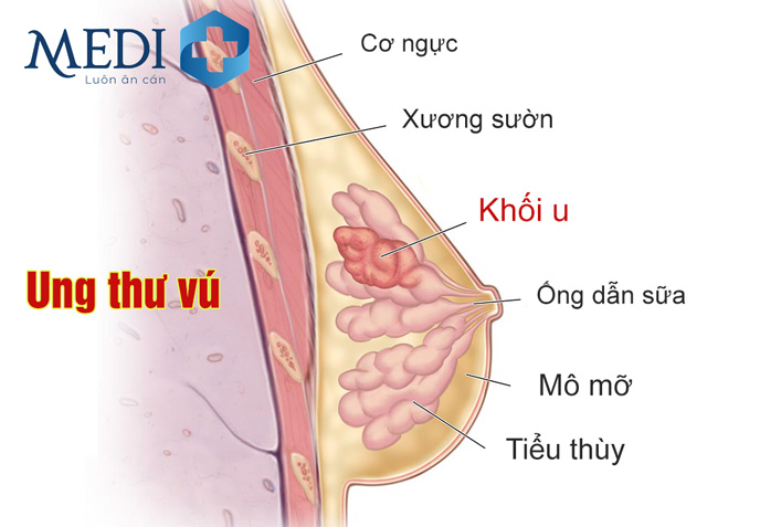 Bệnh ung thư vú: Nhận biết sớm cơ hội điều trị khỏi cao