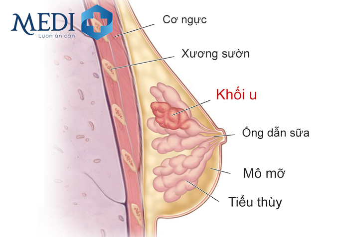 Các khối u ung thư vú phát triển khi các tế bào vú tăng sinh đột biến