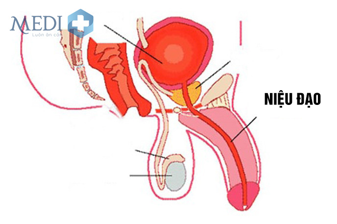 Bệnh viêm niệu đạo sưng tấy hoặc viêm nhiễm