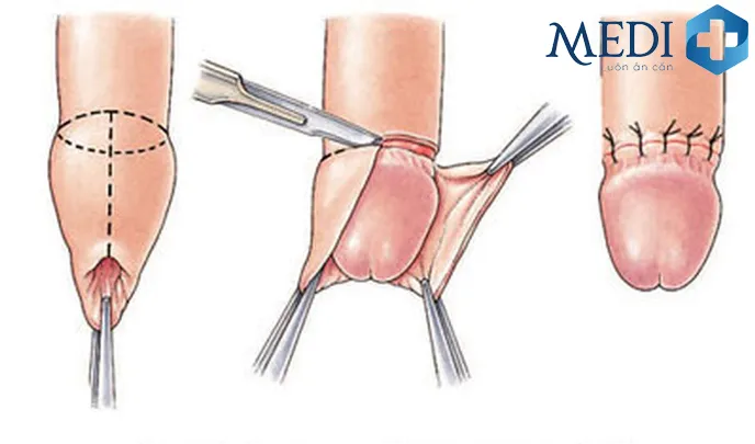 Các bước cắt bao quy đầu theo phương pháp truyền thống