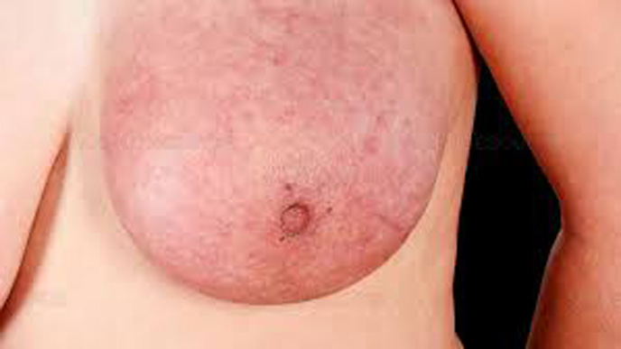 Thay đổi vùng da trước ngực dấu hiệu ung thư vú dễ nhìn thấy