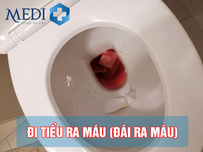 Đi tiểu ra máu (đái ra máu) – Nguyên nhân cần đặc biệt lưu ý