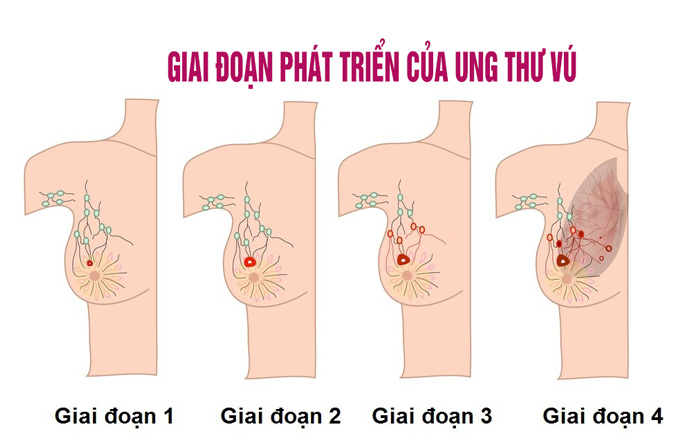 Giai đoạn phát triển của ung thư vú với các triệu chứng khách nhau