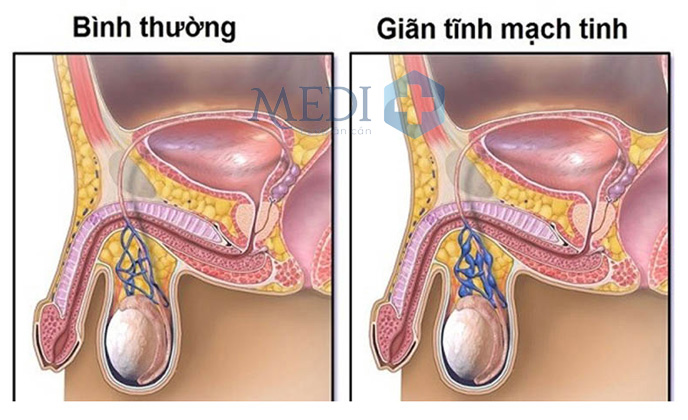 Giãn tĩnh mạch thừng tinh làm giảm lượng máu tới tinh hoàn