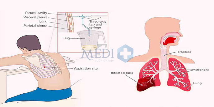 Tràn dịch màng phổi có thể biến chứng nguy hiểm đến sức khỏe