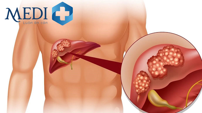 Tràn dịch màng phổi liên quan đến viêm gan