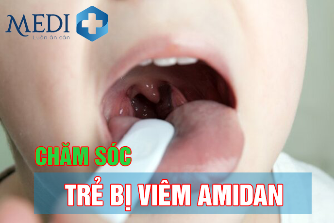 Trẻ bị viêm amidan – Cách chữa đơn giản ngay tại nhà